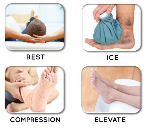 Rest, Ice, Compression, Elevate