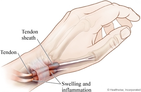 painful tendonitis