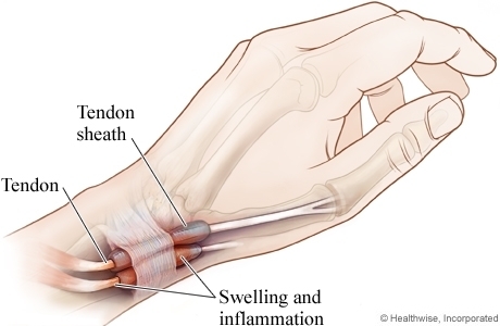 De Quervain's Tenosynovitis Causes, Symptoms, Treatment