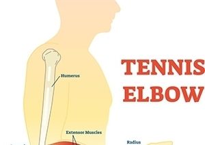 tennis elbow