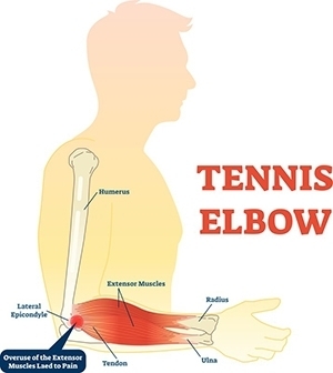 tennis elbow