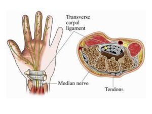 symptoms of carpal tunnel syndrome
