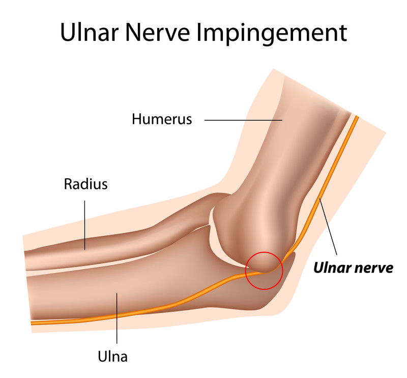 Cubital Tunnel Syndrome