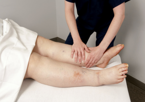 Lymphedema therapy