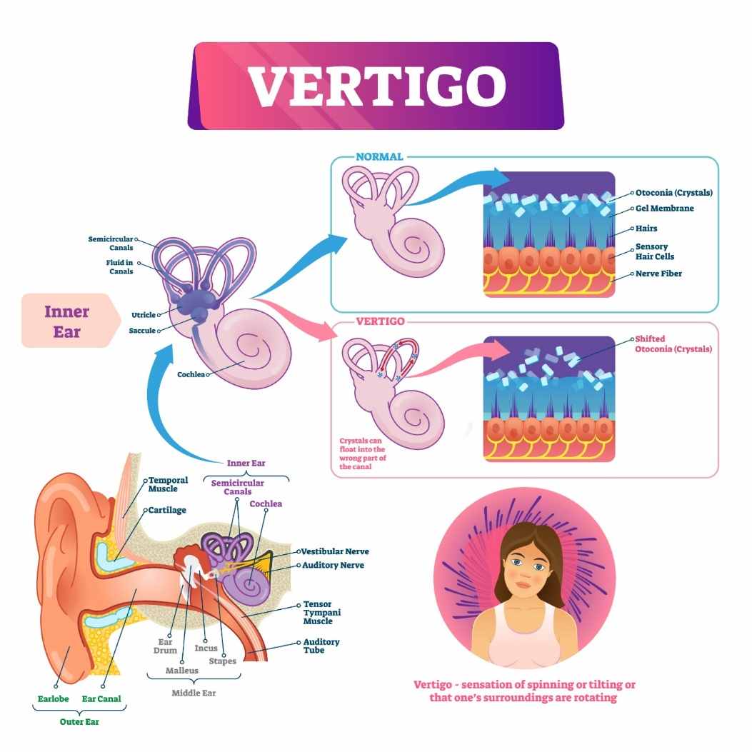 symptoms of vertigo