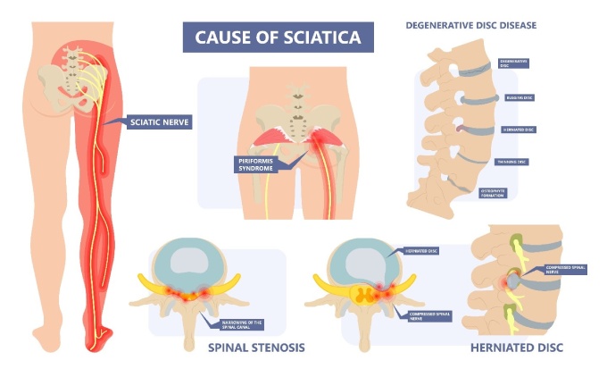 cause of sciatica