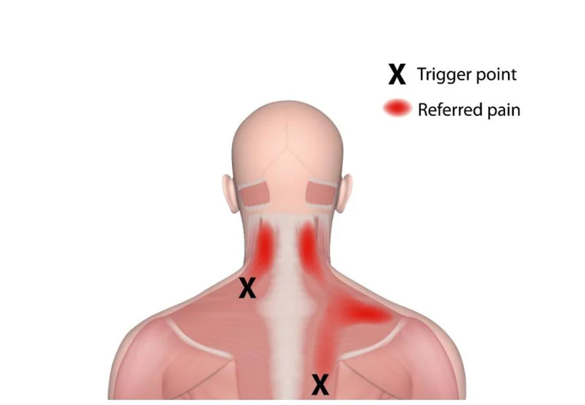 referred pain