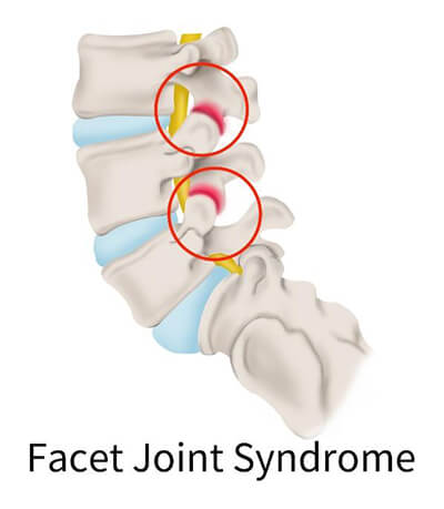 spine facet joint syndrome