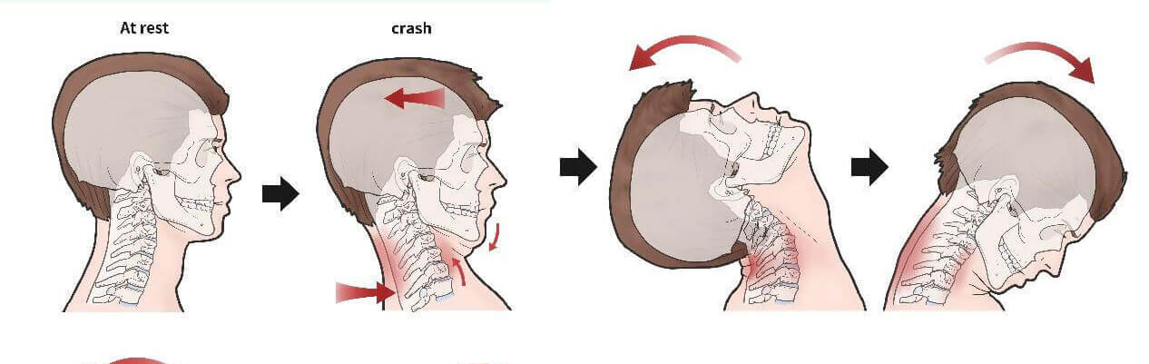 whiplash associated disorders injuries