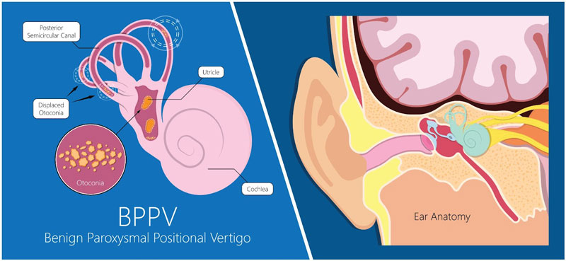 BBPV-vertigo treatment