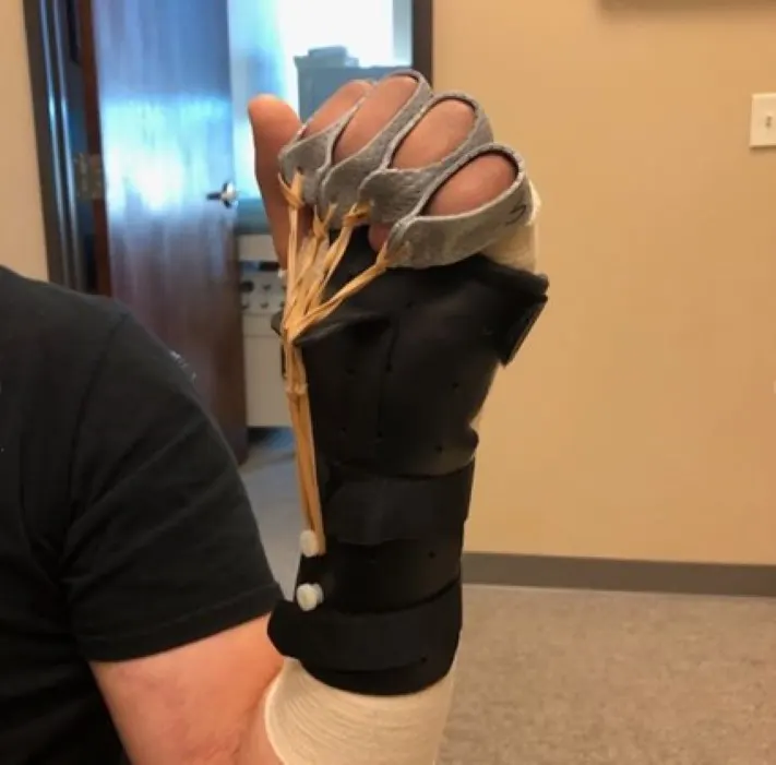 Custom Splinting Treatment